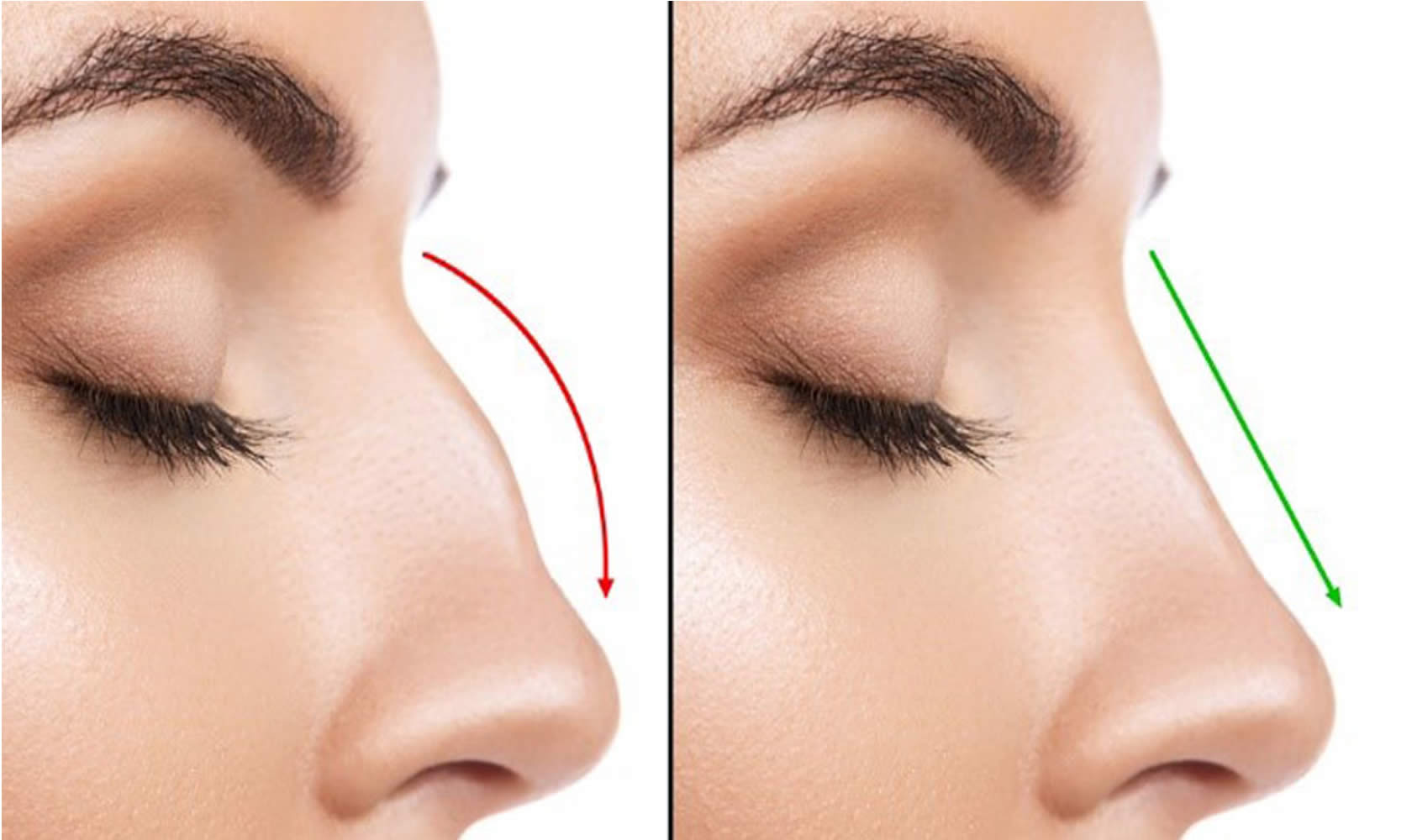 rinoplastia-quito